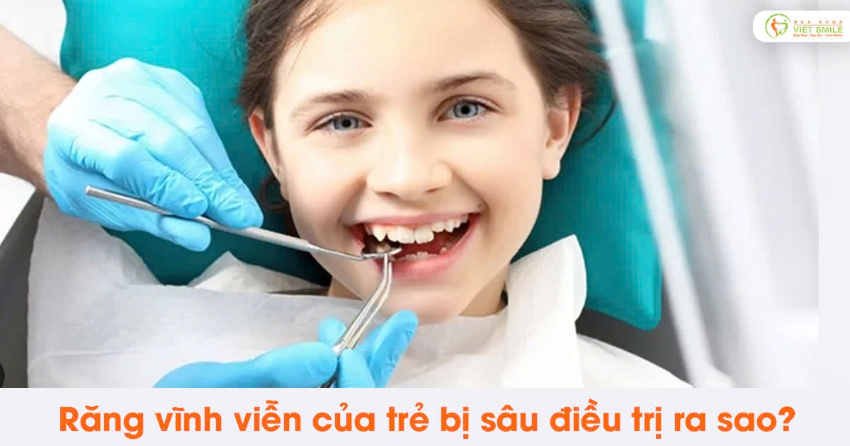 Răng vĩnh viễn của trẻ bị sâu điều trị ra sao?