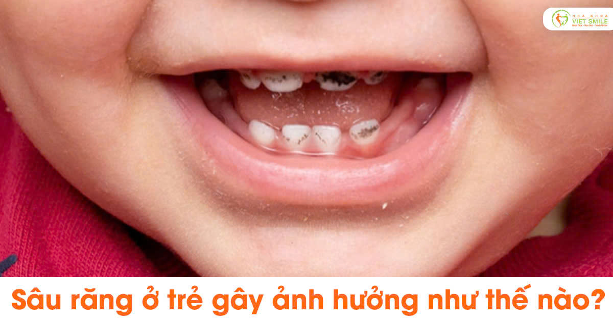 Sâu răng ở trẻ gây ảnh hưởng như thế nào?