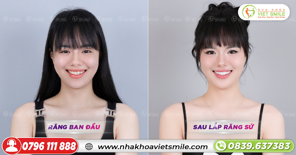 Thay đổi hoàn toàn nụ cười sau bọc răng sứ