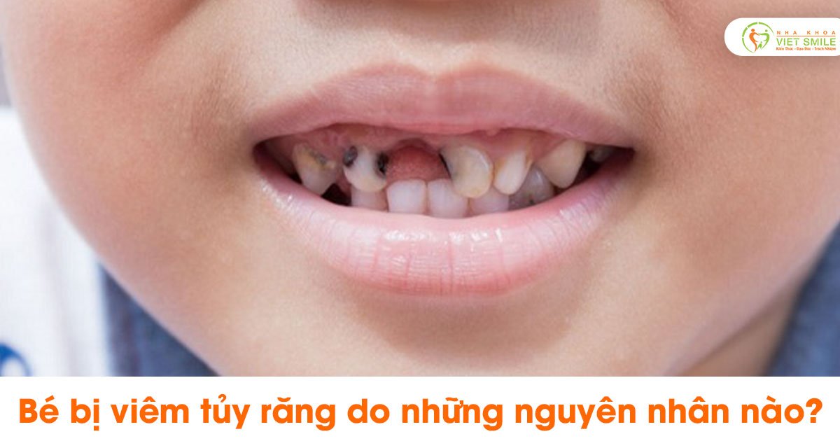 Trẻ bị sâu răng ăn vào tủy là như thế nào? Điều trị ra sao?