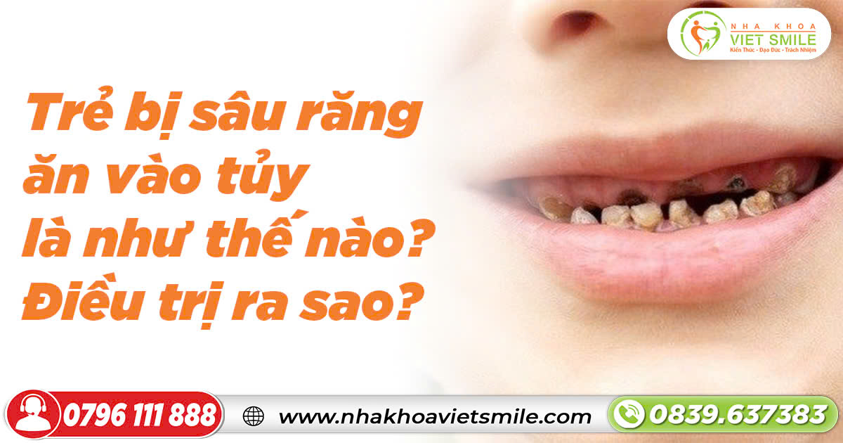 Trẻ bị sâu răng ăn vào tủy là như thế nào? Điều trị ra sao?