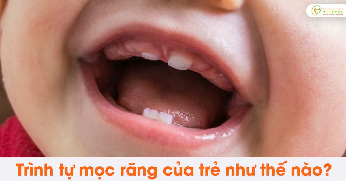 Trình tự mọc răng của trẻ như thế nào?