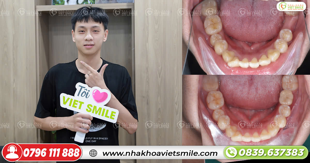 Trồng răng implant ăn nhai như răng thật