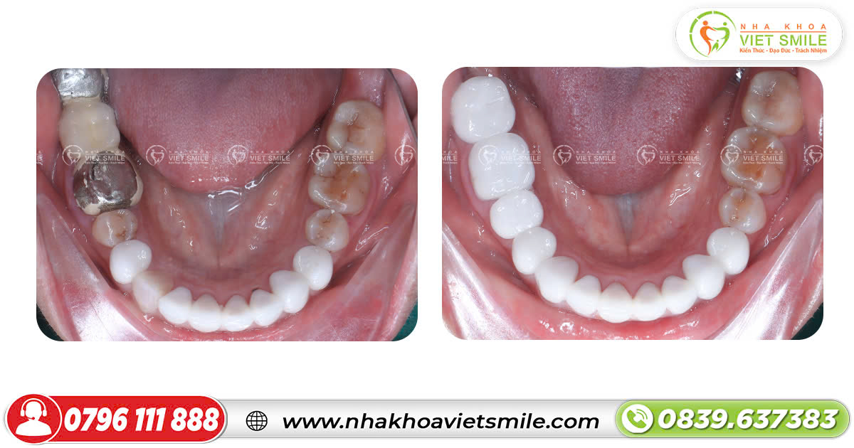 Răng implant đẹp như răng thật