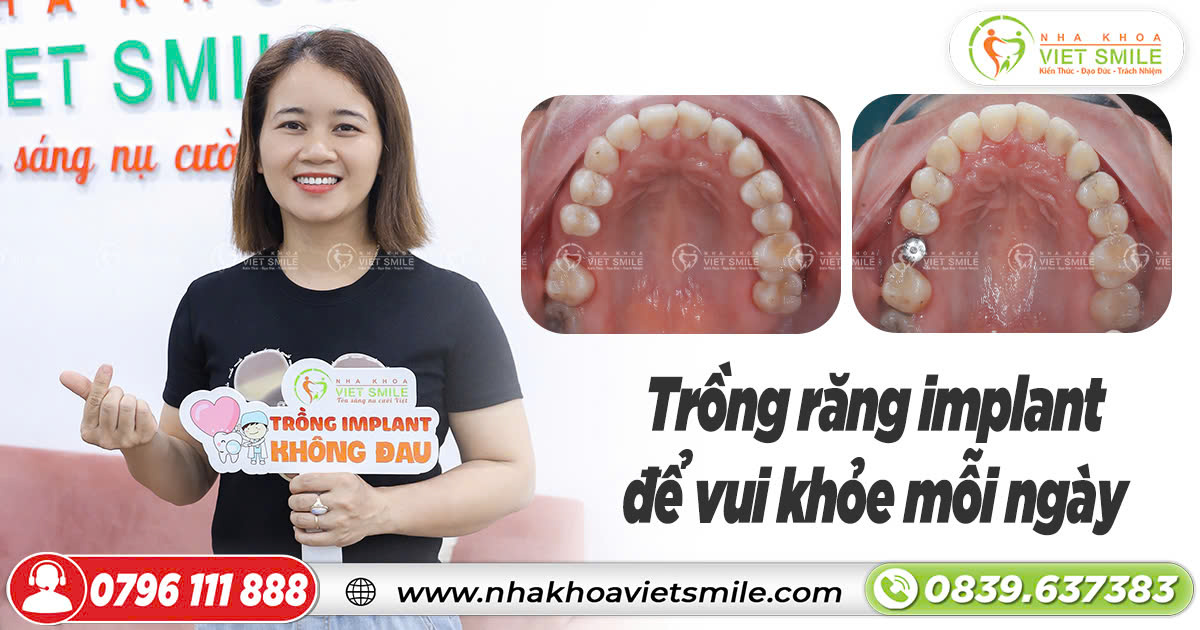 Trồng răng implant để vui khỏe mỗi ngày 