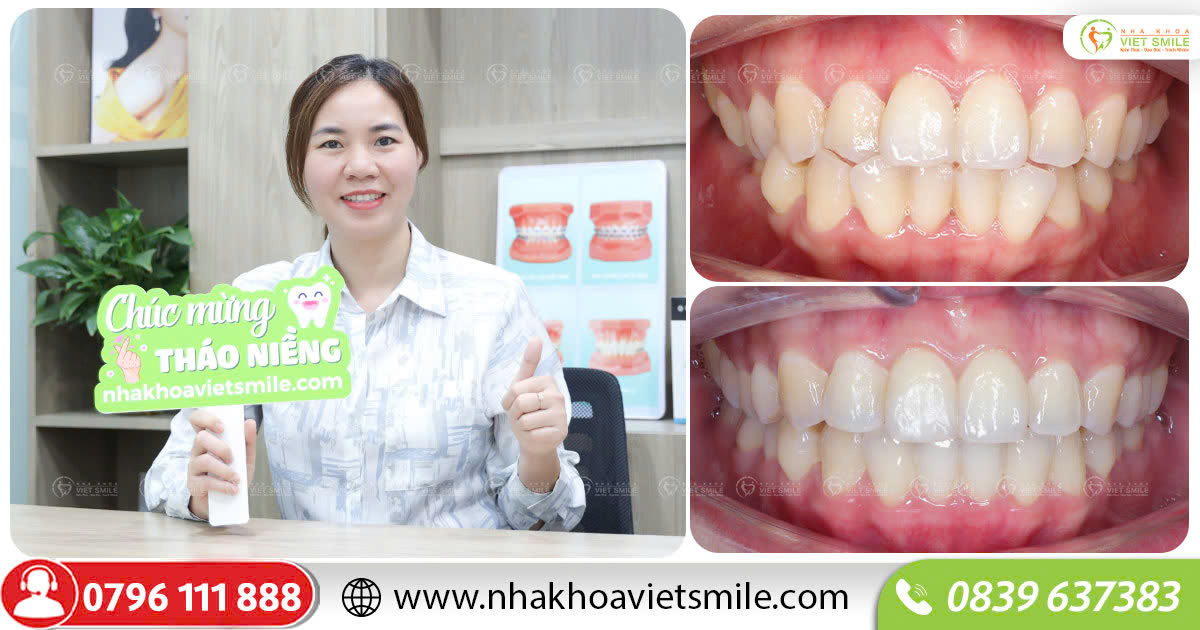 Hàm răng đẹp như mơ sau niềng invisalign