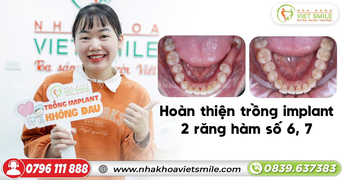 Hoàn thiện cấy 2 răng implant 6,7