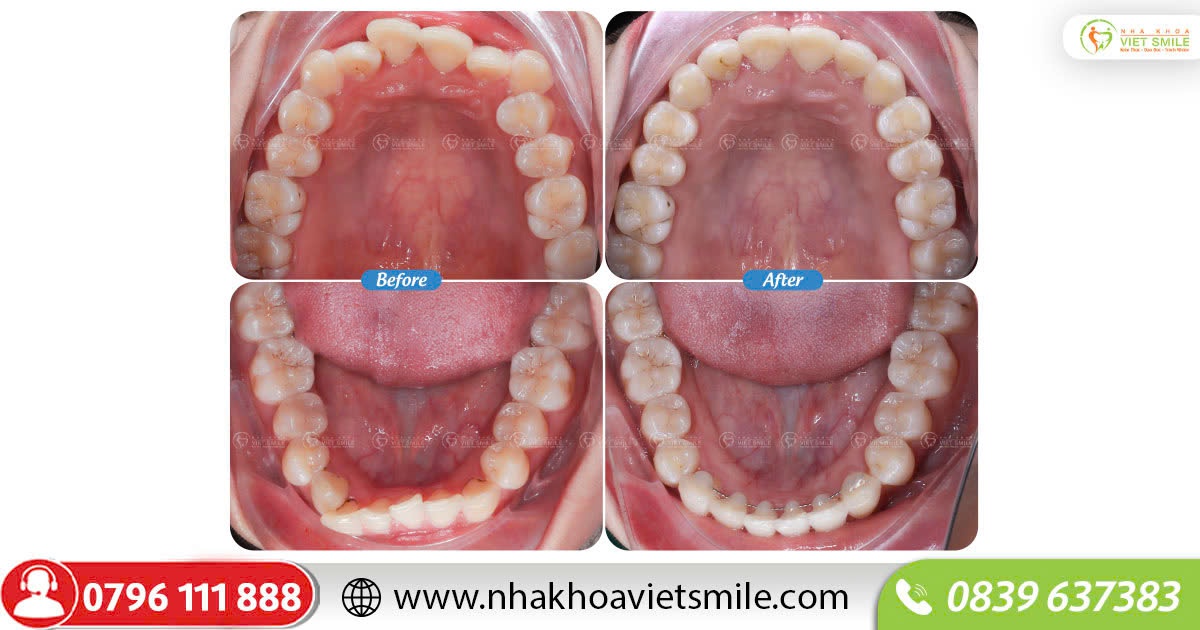 Cung răng tròn đều sau niềng