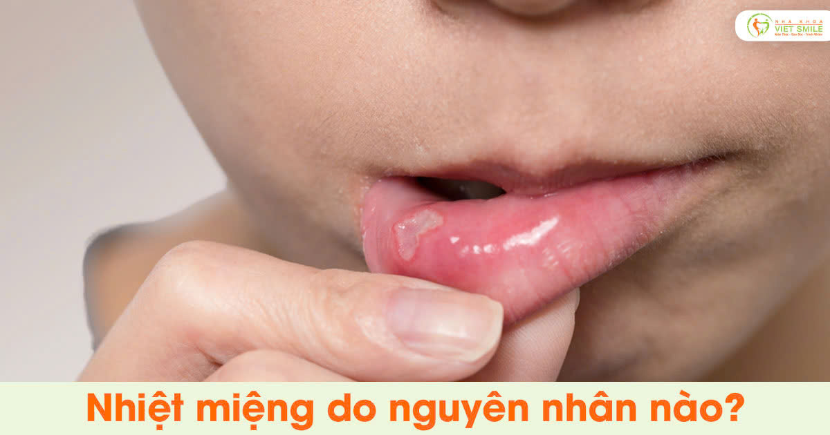 Nhiệt miệng do nguyên nhân nào?