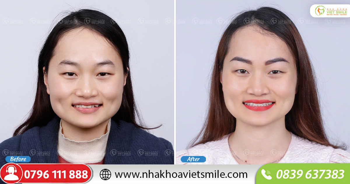 Thay đổi hoàn toàn sau niềng răng invisalign