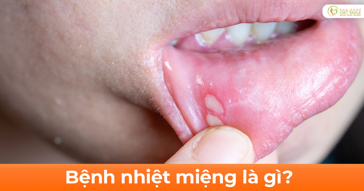 Bệnh nhiệt miệng là gì