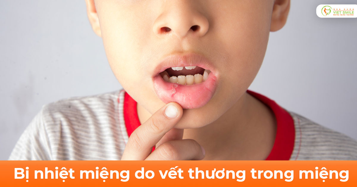 Bị nhiệt miệng do vết thương trong miệng