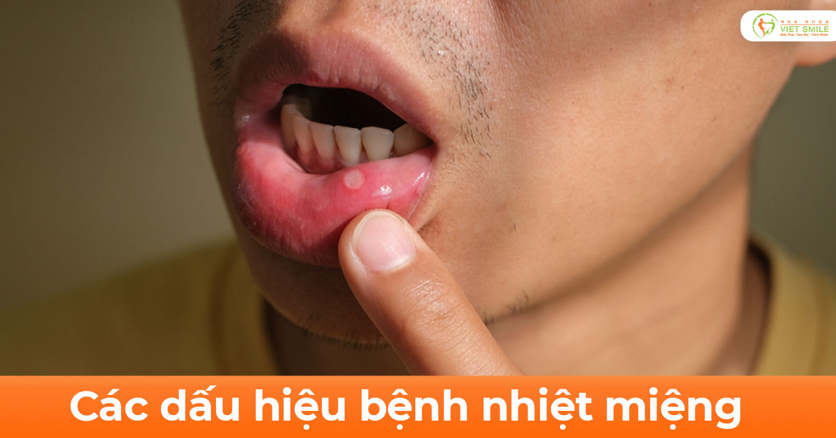 Các dấu hiệu bệnh nhiệt miệng