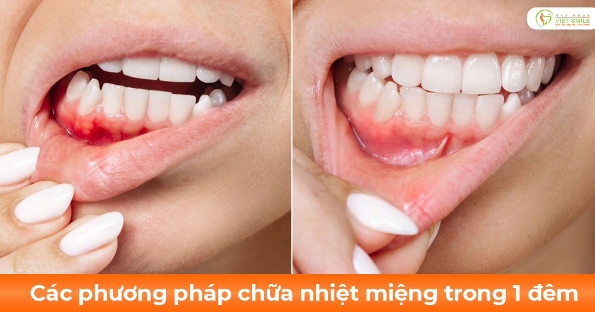 Các phương pháp chữa nhiệt miệng trong 1 đêm