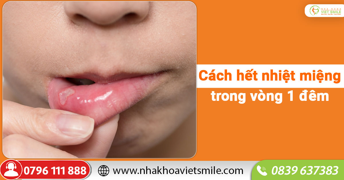 Cách hết nhiệt miệng trong vòng 1 đêm