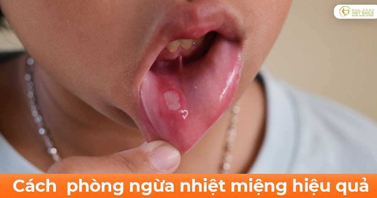 Cách phòng ngừa nhiệt miệng hiệu quả