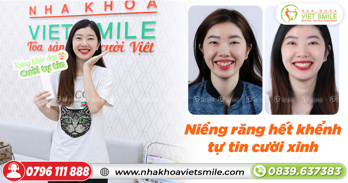 Niềng răng hết khấp khểnh, tự tin cười xinh