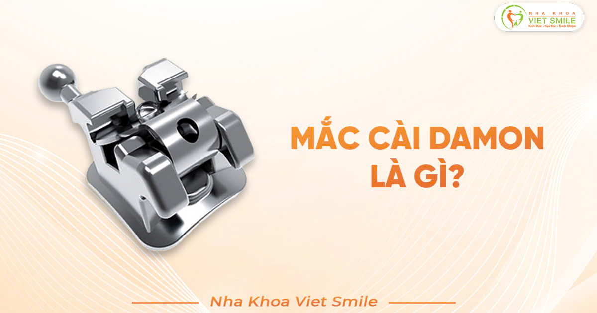 Mắc cài damon là gì