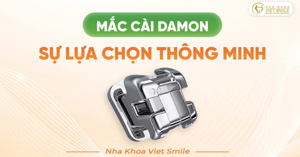 Mắc cài damon sự lựa chọn thông minh