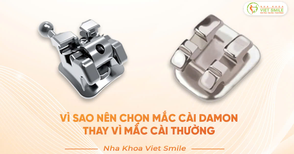 Vì sao nên chọn mắc cài Damon thay vì mắc cài thường