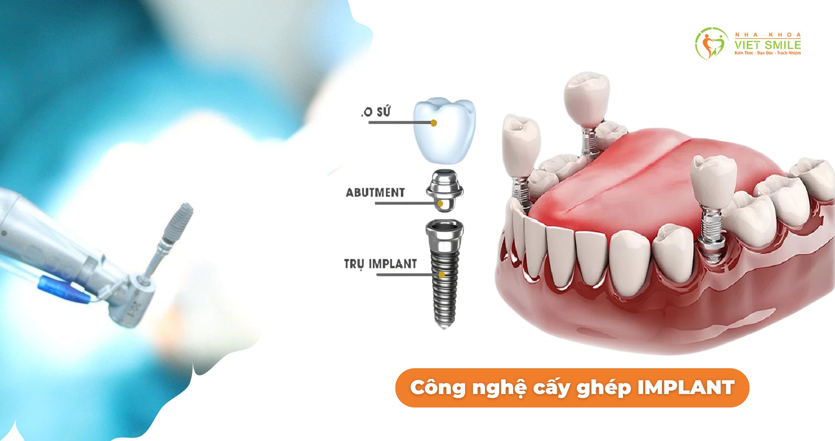 Trồng răng Implant