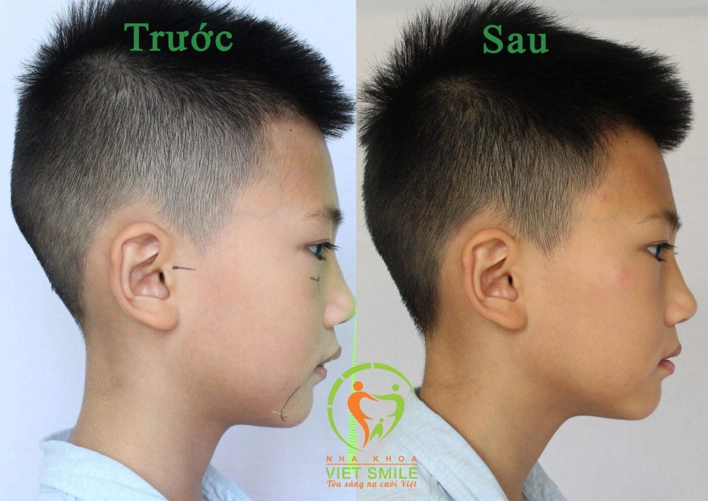 khi nào nên niềng răng cho trẻ? 2 Đừng lơ là bỏ lỡ mất giai đoạn vàng chỉnh nha của bé