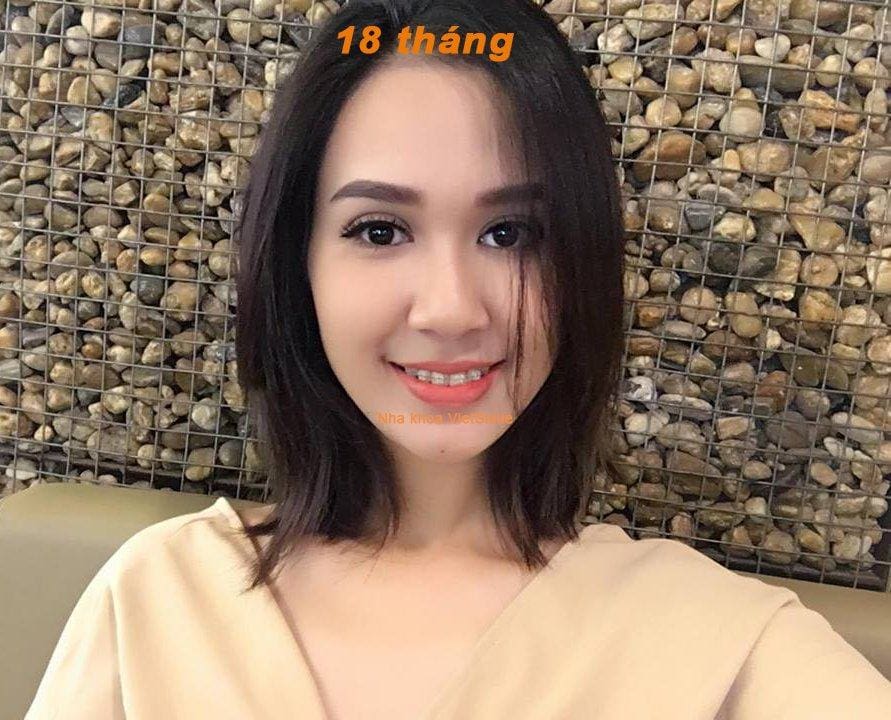 niềng răng là gì? lợi ích của niềng răng là gì? 1 Nieng rang nha khoa viet smile