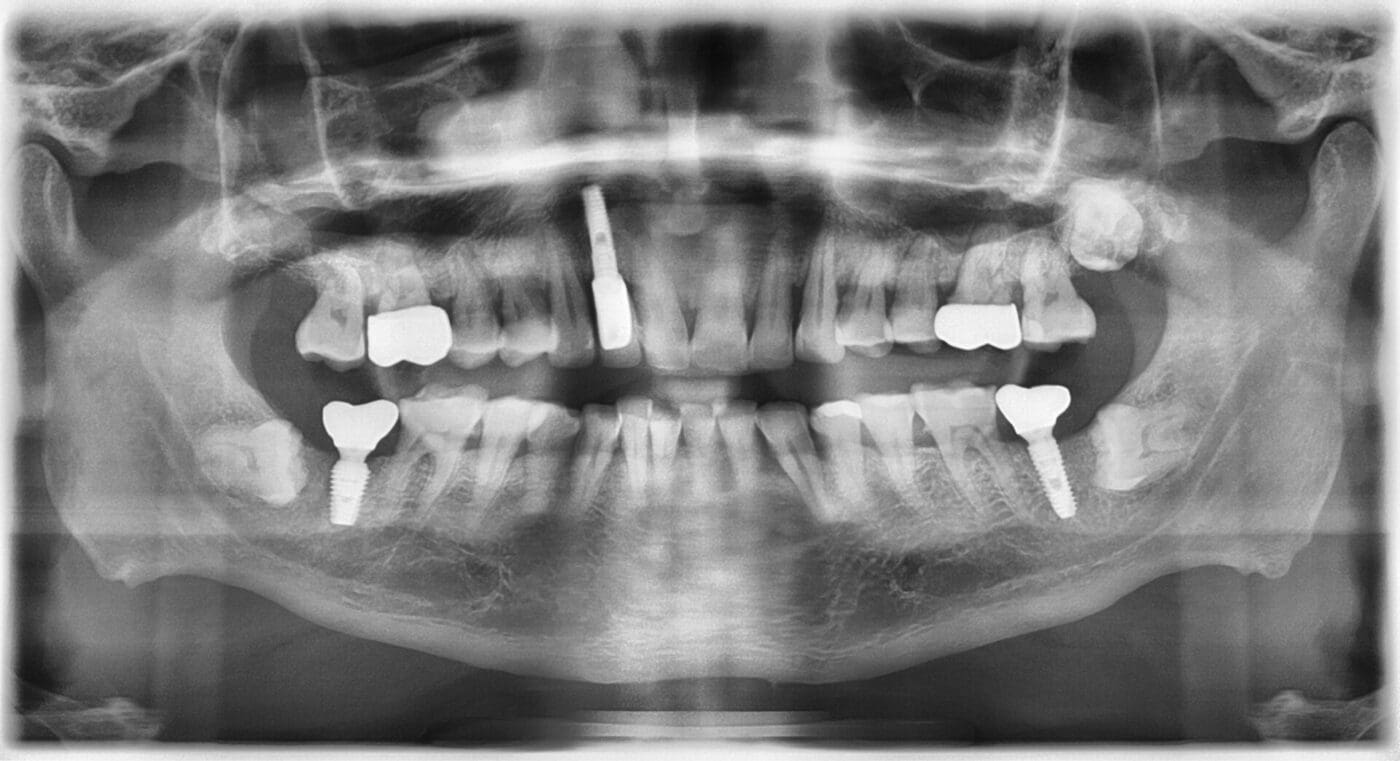 Hình chụp Xquang sau khi cấy ghép implant và phục hình