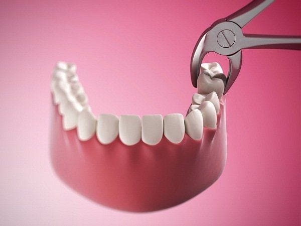 nhổ răng số 8: thời điểm nào tốt nhất để nhổ răng khôn? 1 Nhổ răng số 8: thời điểm nào tốt nhất để nhổ răng khôn?