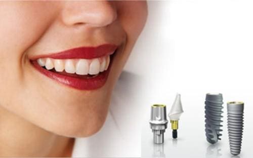 Tận hưởng nụ cười mới sau khi phục hình trên implant