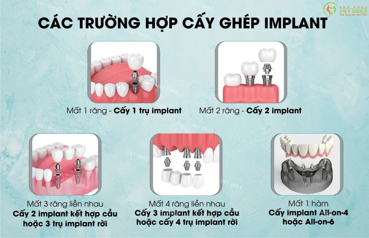 cấy ghép implant 7 Các trường hợp cấy ghép implant