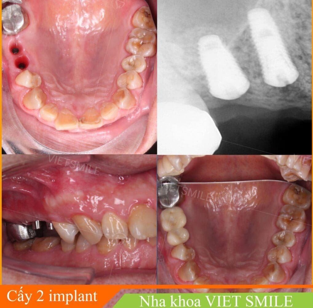 Cấy ghép implant cho khách hàng mất 2 răng liền kề