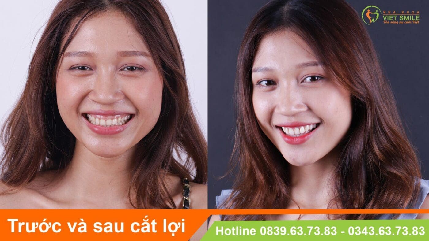 cười hở lợi 7 Kết quả sau khi cắt lợi thẩm mỹ của khách hàng tại việt smile