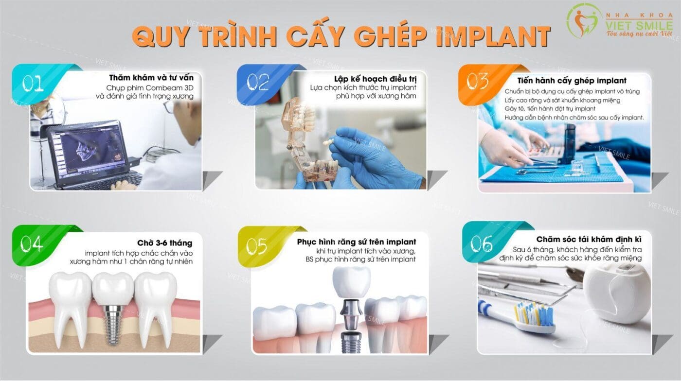 Quy trình cấy ghép implant tiêu chuẩn